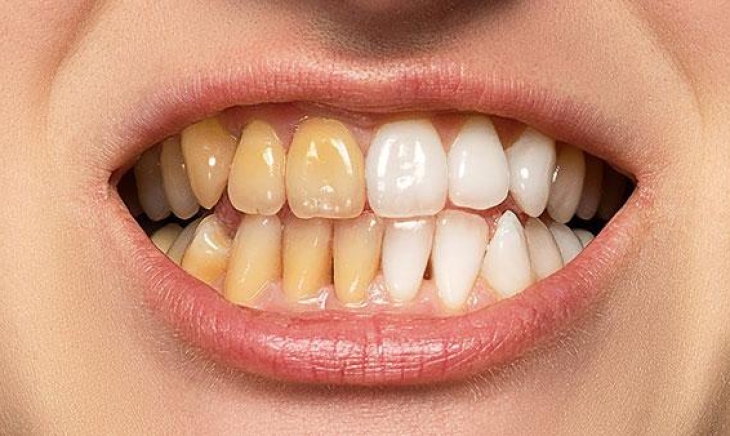 مشكلة التصبغات في الأسنان