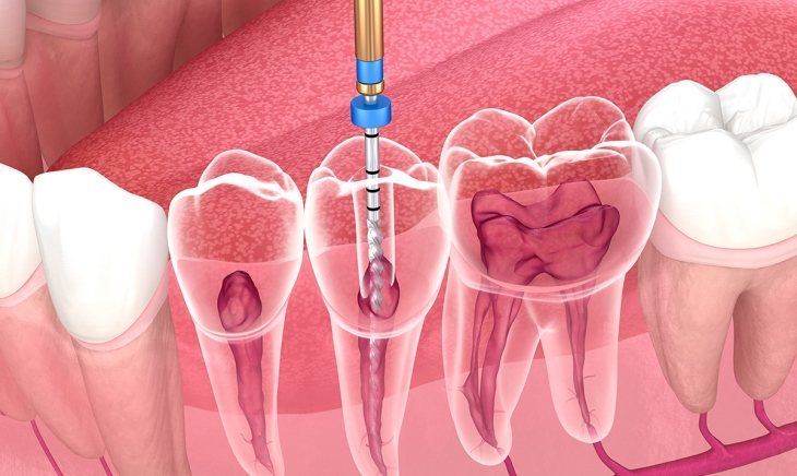 خطوات علاج قناة الجذر