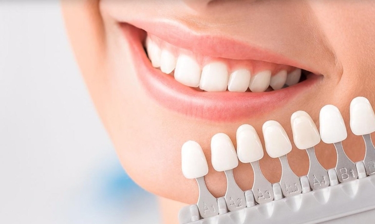 Types of Veneers and Their Pros and Cons